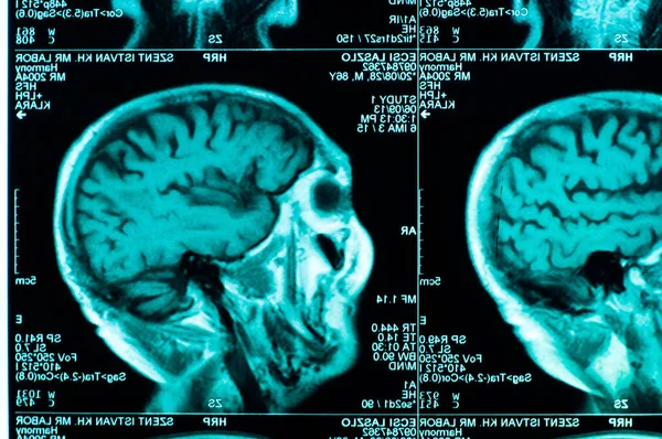 Scan Human Brain Tile — Stock Photo, Image