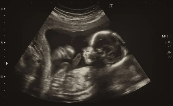 Ultraschalluntersuchung Eines Fetus Monat Italien — Stockfoto