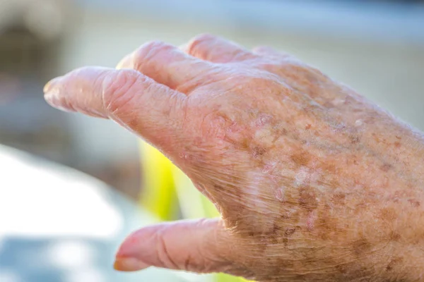 Manos Una Mujer Anciana Con Eccema Problemas Alérgicos Piel —  Fotos de Stock