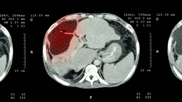 Abdômen Superior Mostrar Massa Anormal Fígado Câncer Fígado — Fotografia de Stock