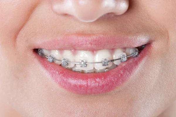 Zęby Szelkami Ścieśniać Młoda Kobieta Zdjęcie — Zdjęcie stockowe