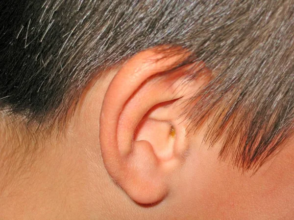 Ear Wax in the Ear of a Young Boy