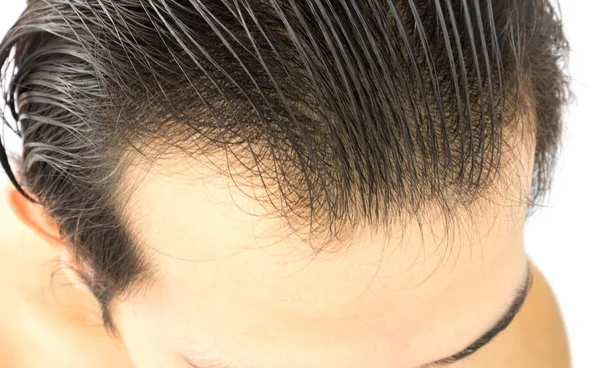 Closeup Tânăr Problemă Serioasă Cădere Părului Pentru Șampon Îngrijire Sănătății — Fotografie, imagine de stoc