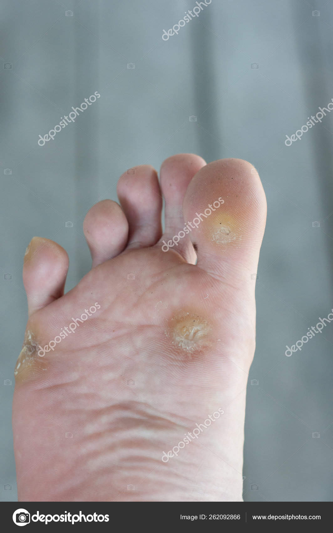Foot Warts Corn Close — Stock Photo © YAYImages #262092866