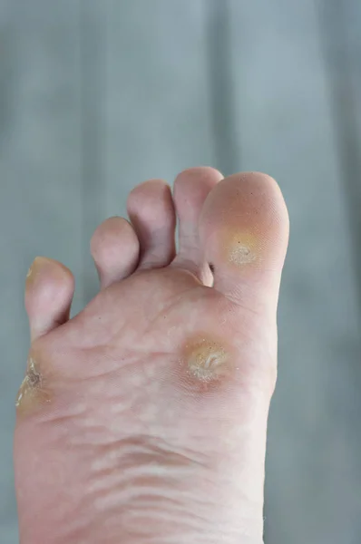 Foot Warts Corn Close — Stock Photo, Image