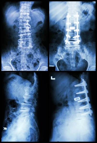 Espondilose Espondilolistese Foi Operada Fixada Internamente Coluna Vertebral Imagem Esquerda — Fotografia de Stock