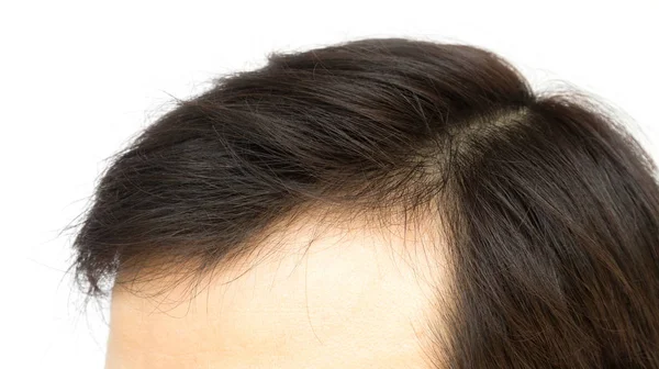 Mladý Muž Vážné Vlasy Ztráta Problém Pro Zdravotní Péče Šampon — Stock fotografie