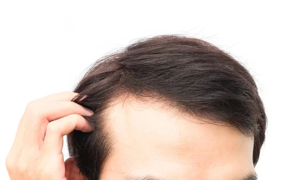 Penutup Anak Muda Serius Masalah Rambut Kehilangan Konsep Untuk Rambut — Stok Foto