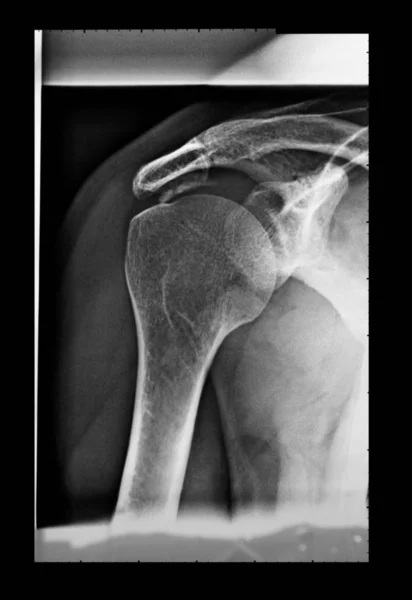 Imagem Radiológica Médica Ombro Usada Radiologia Diagnóstica Ossos Esqueleto — Fotografia de Stock
