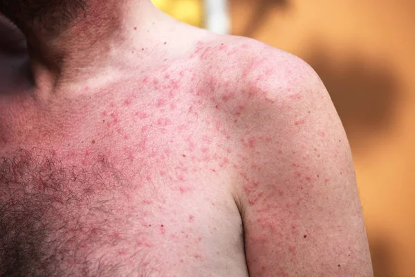 Erupção Cutânea Alergia Sol Espinhas Vermelhas Pele — Fotografia de Stock