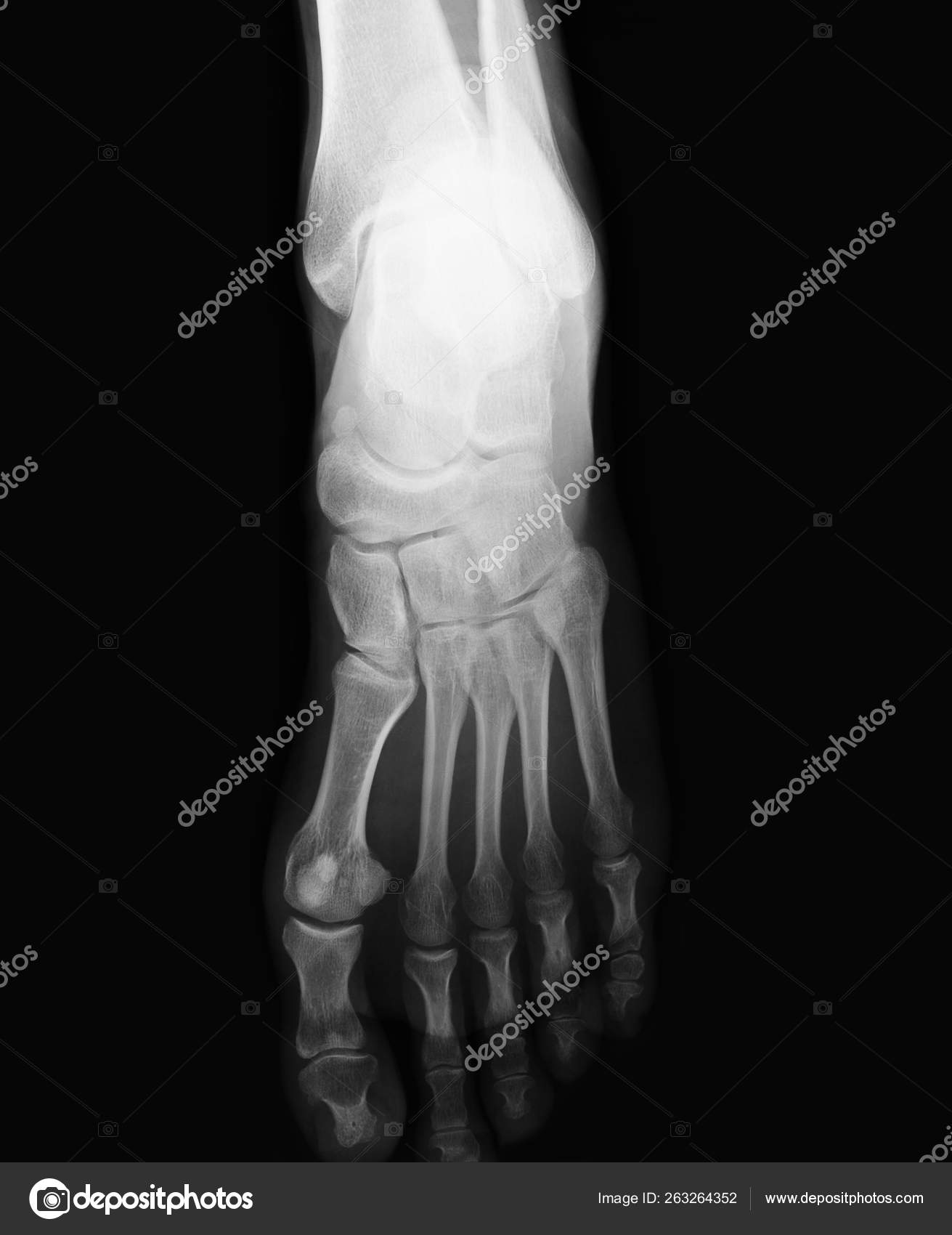 Foot Xray Top View Stock Editorial Photo © YAYImages 263264352