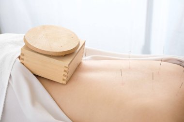 Parlak bir akupunktur kliniğinde bir kadının kalçasına konmuş kutu moxa.