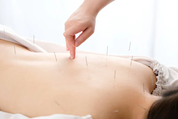 Eine Frau Bekommt Einer Hell Erleuchteten Akupunkturklinik Eine Nadel Den — Stockfoto