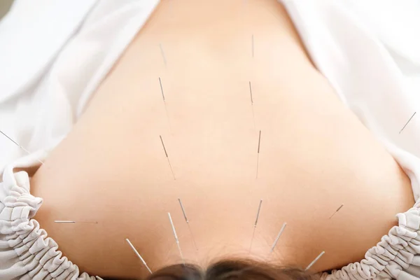 A woman gets a needle in her back in a brightly lit acupuncture clinic
