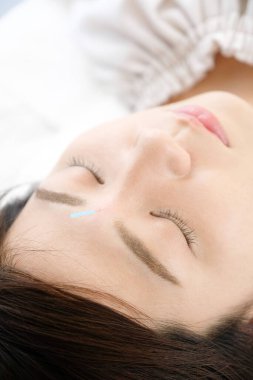 Bir kadının akupunktur kliniğinde yüzüne akupunktur yaptırması...