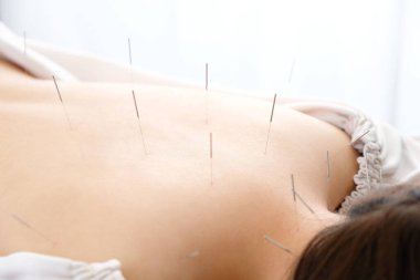Parlak bir akupunktur kliniğinde sırtına iğne saplanmış bir kadın.