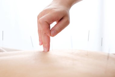 Parlak bir akupunktur kliniğinde sırtına iğne saplanmış bir kadın.