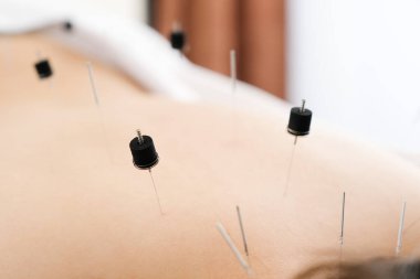 Parlak bir akupunktur kliniğinde sırtına iğne saplanmış bir kadın.
