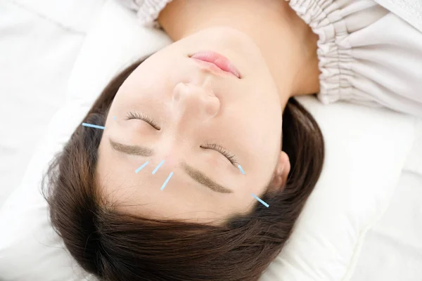 Up of a woman getting acupuncture on her face at an acupuncture clinic