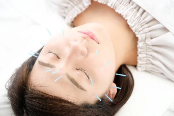 Up of a woman getting acupuncture on her face at an acupuncture clinic