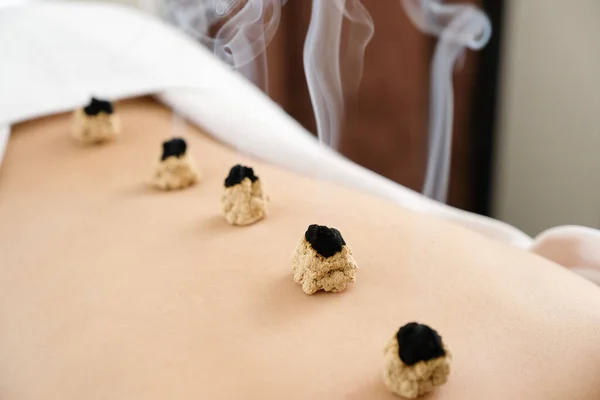 Βελονισμός Και Moxibustion Στην Πλάτη Μιας Γυναίκας Ένα Φωτεινό Κέντρο — Φωτογραφία Αρχείου