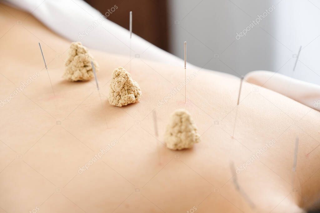 Acupuncture and moxibustion on the back of a woman in a bright acupuncture center