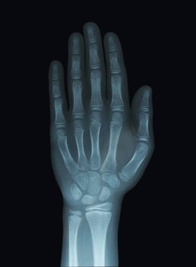 Child Hand X-Ray negative showing Unclosed Epiphysis of the Bone. clipart