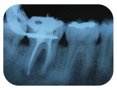 X-Ray Negative of Tooth Endodontic clipart