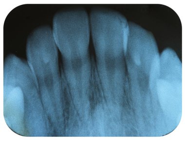 X-Ray Negative Film of the Tooth Incisors clipart