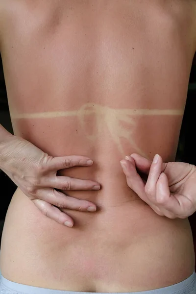 Parte posterior de una mujer caucásica con la piel roja después de tomar el sol. Las manos femeninas fingen desatar las correas de un bikini, después de broncearse . —  Fotos de Stock