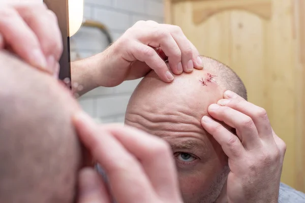 Dans Miroir Homme Examine Une Blessure Avec Des Sutures Sur — Photo