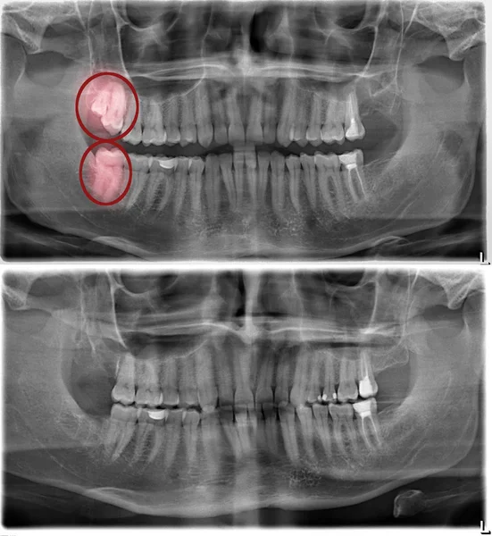 Imágenes de radiografía antes y después de la eliminación de tres sabiduría — Foto de Stock