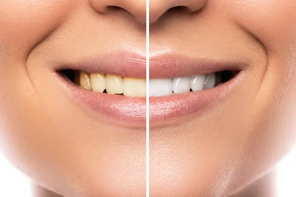Zbliżenie Kobiece Usta Porównanie Wybielanie Zębów — Zdjęcie stockowe