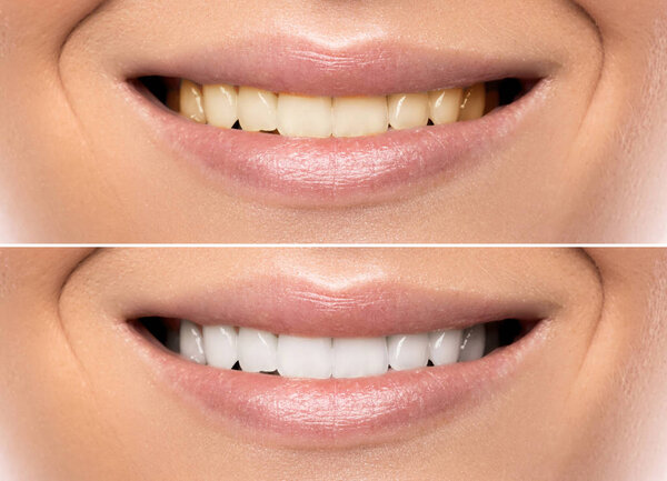 Close up of female mouth. Comparison after teeth whitening