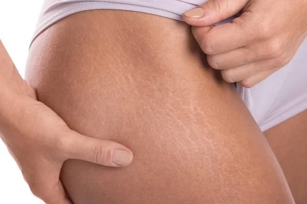 Close View Female Hips Stretch Marks — Stock Photo, Image