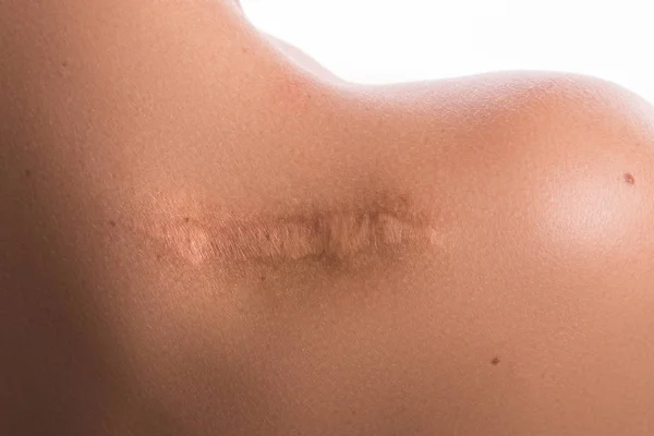 Vista Vicino Della Spalla Femminile Con Una Cicatrice — Foto Stock