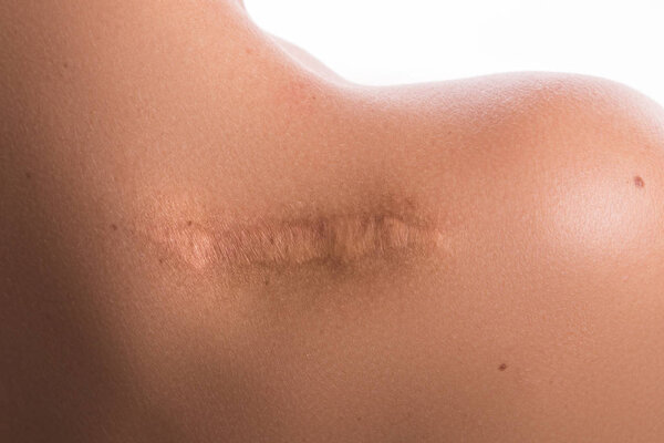 Close up view of female shoulder with a scar