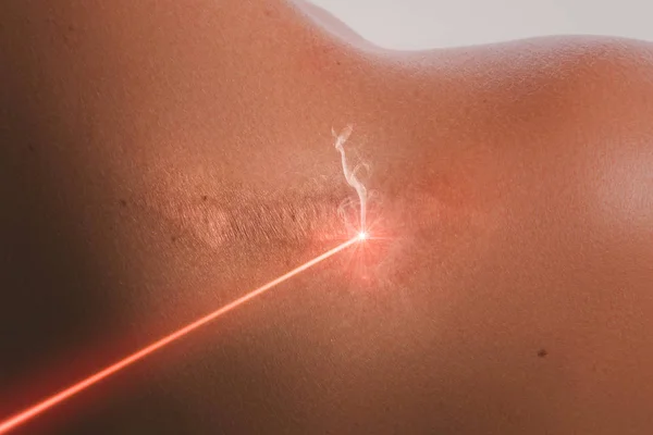 Ombro Feminino Feixe Laser Durante Tratamento Remoção Cicatriz — Fotografia de Stock