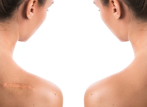 Comparação Ombro Feminino Após Procedimento Remoção Cicatriz — Fotografia de Stock