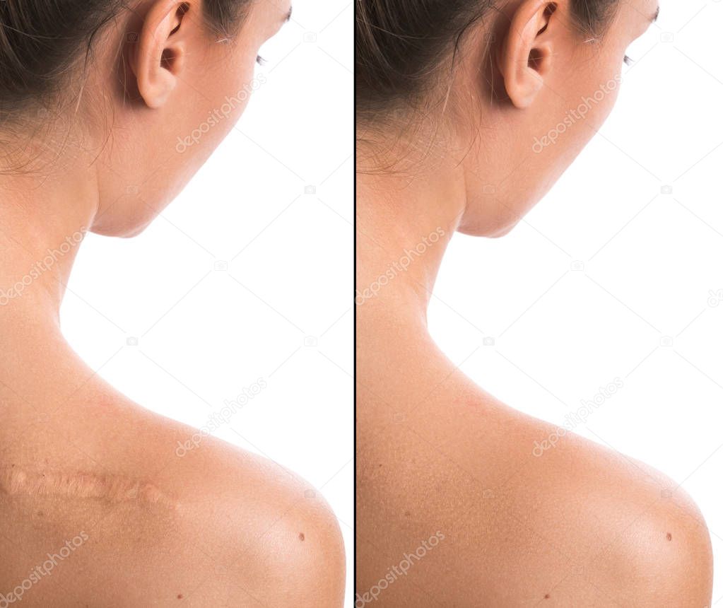 Comparision of female shoulder after scar removing procedure