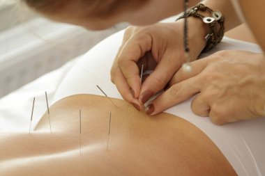 Alternatif Tıp. Akupunktur tedavisi işlem sırasında çelik iğne enjekte Master.