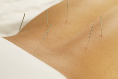 Alternatif Tıp. Kadın arka görünümü çelik iğne Akupunktur tedavisinin işlem sırasında kapatın.