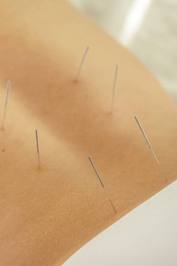 Alternatif Tıp. Kadın arka görünümü çelik iğne Akupunktur tedavisinin işlem sırasında kapatın.