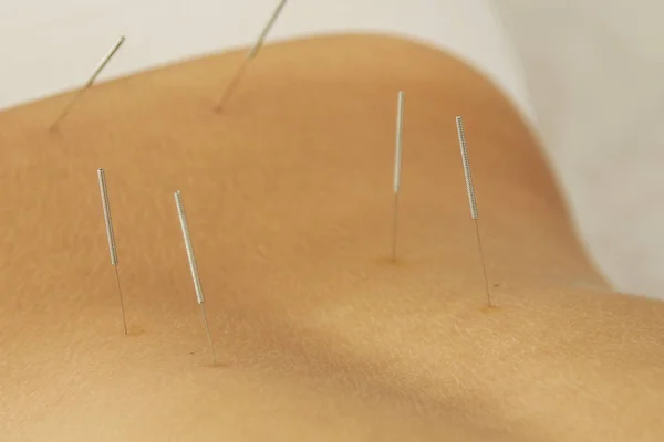 Alternative medicine. Close up view of female back with steel needles during procedure of acupuncture therapy