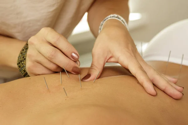 Medicina Alternativa Agulhas Aço Injeção Mestre Durante Procedimento Terapia Acupuntura — Fotografia de Stock