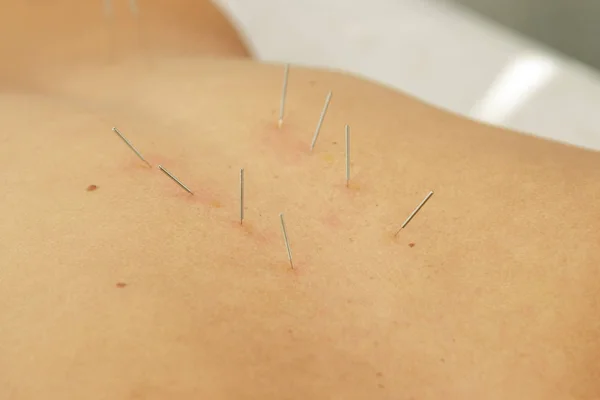 Medicina Alternativa Vista Cerca Espalda Femenina Con Agujas Acero Durante —  Fotos de Stock