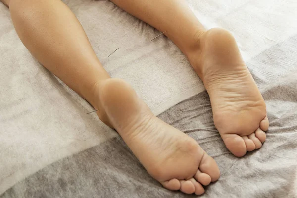 代替医療 鍼治療の手順中に鋼の針でクローズ アップ女性の足の表示 — ストック写真