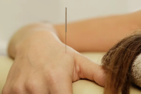 代替医療 鍼治療の手順中に鋼の針でクローズ アップ女性の腕の表示 — ストック写真