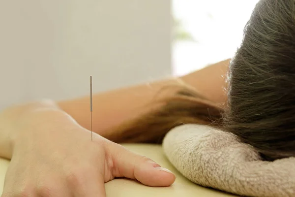 Medicina Alternativa Vista Ravvicinata Del Braccio Femminile Con Aghi Acciaio — Foto Stock