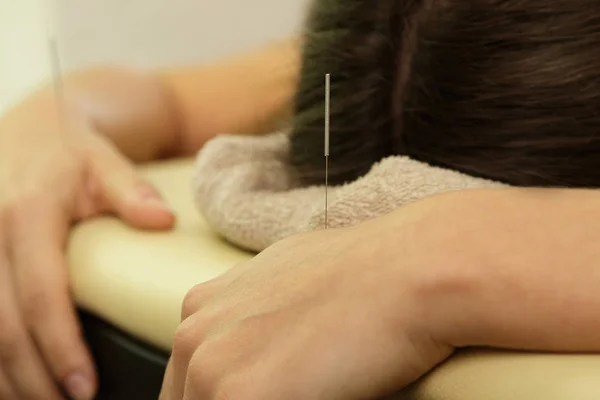 Alternative Medicine Close View Female Arm Steel Needles Procedure Acupuncture — Stock Photo, Image